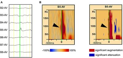 The Onset of Interictal Spike-Related Ripples Facilitates Detection of the Epileptogenic Zone